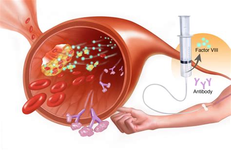 Clinical Management of Inhibitors in Children With Hemophilia ...