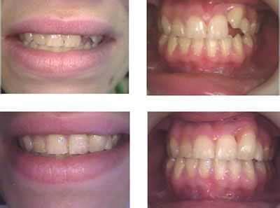 Bonding gaps between teeth with high end composite resins.