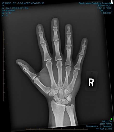 This is the X-ray, look at my ring finger. | Broken finger, Hand fracture, Hand pin