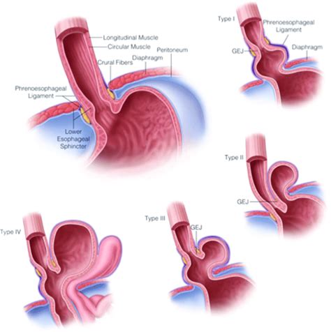 Normal anatomy of the esophageal hiatus shown with examples of ...