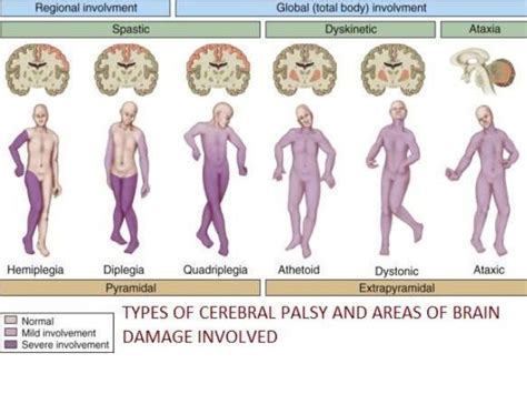 Cerebral palsy