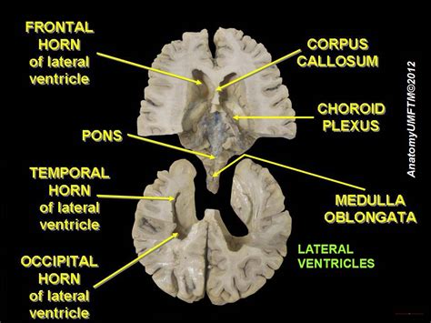 Posterior Horn Of Lateral Ventricle