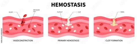 Hemostasis Hemophilia wound healing injury bleeding coagulation blood Fibrin platelet plug ...