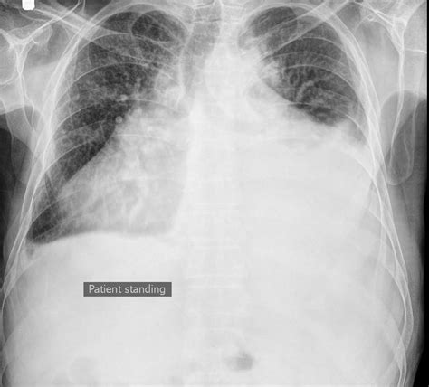 Pleural effusion causes, types, symptoms, diagnosis and treatment