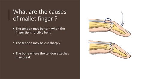 Mallet Finger Explained by Dr Alexander Anzarut - YouTube