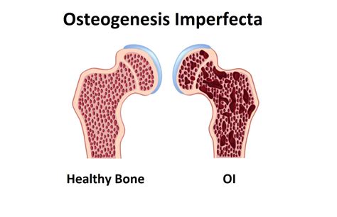 Osteogenesis Imperfecta | News | Dentagama