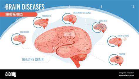 Flat cartoon infographic brain diseases vector illustration concept ...