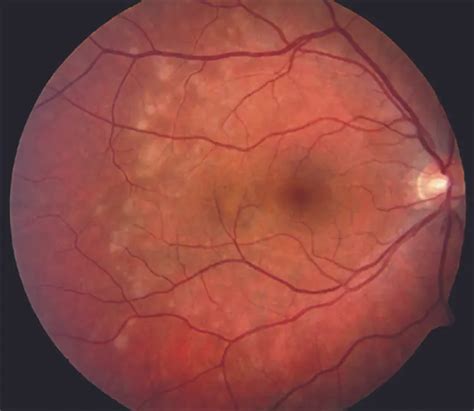 White dot syndrome - American Academy of Ophthalmology