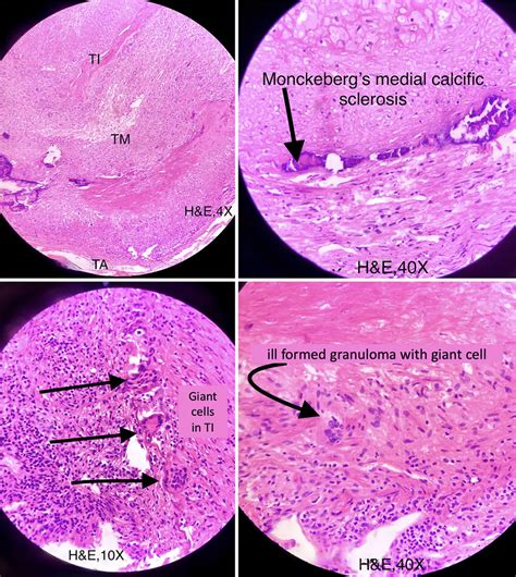 Histopathological features of the biopsy specimen (TI, tunica intima ...