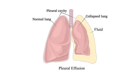 Pleural Effusion Wikipedia, 55% OFF | www.gf-planen.de