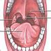 Herpangina - Symptoms, Diagnosis, Treatment of Herpangina - NY Times Health Information