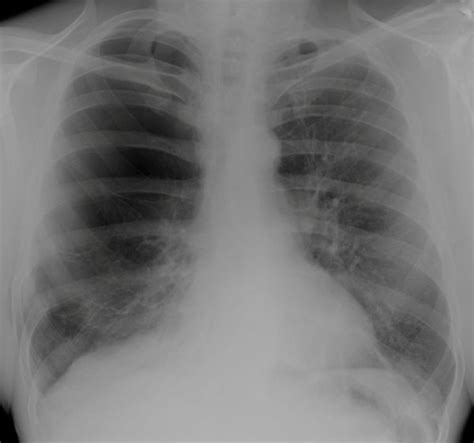 CXR Case 006 • LITFL • Chest X-ray Self-Assessment Quiz