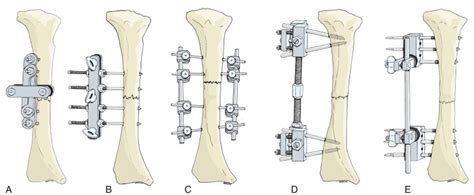 Principles and Complications of External Skeletal Fixation | Musculoskeletal Key