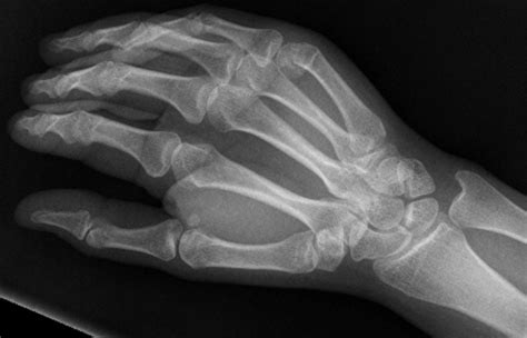 X Ray Of A Cracked Wrist