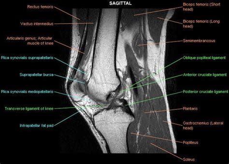 ANTERIOR CRUCIATE LIGAMENT INJURY | Knee mri, Cruciate ligament, Ligament injury