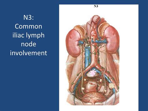 Common Iliac Lymph Nodes