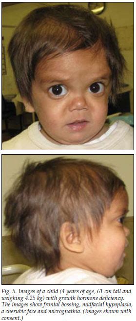 Growth hormone deficiency toddler | doctorvisit