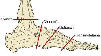 Image result for syme amputations | Lower extremity