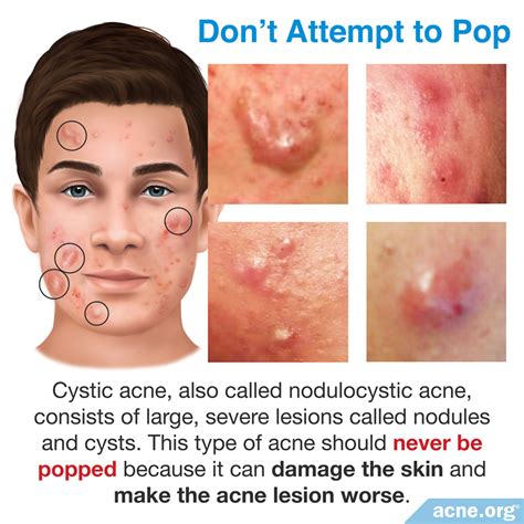 Should You Pop Cystic Acne? - Acne.org