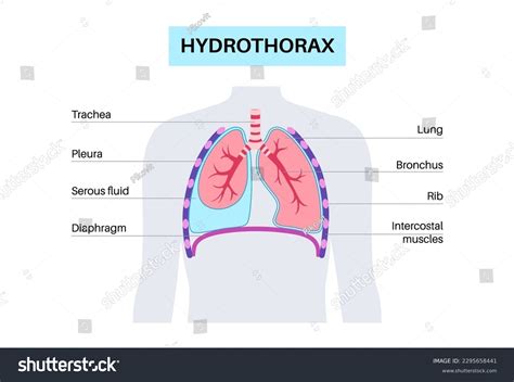 Hydrothorax Lungs Disease Noninflammatory Serous Fluid Stock Vector ...