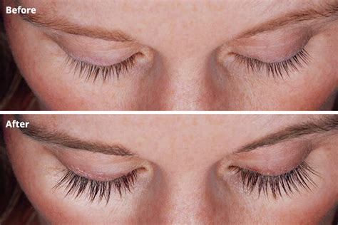 Latisse for Longer Eyelashes: Safe for Your Eyes?