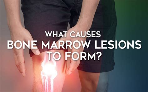 What Causes Bone Marrow Lesions to Form? | iO-Core