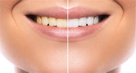 3 Reasons to Ditch Teeth Whitening Kits - PB Smile Studio