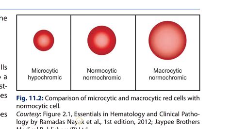 Comparision of micro & macrocytic red cells with normocytic red cell ...