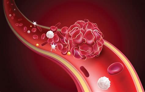 How to Prevent Blood Clots After Your Surgery: Orthopaedic Specialists ...