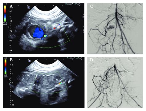 (A) Colour Doppler ultrasound of the right common iliac artery aneurysm... | Download Scientific ...