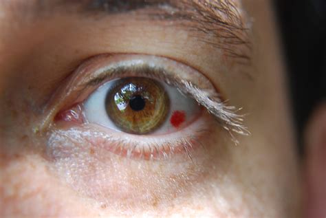 Subconjunctival Hemorrhage | Subconjunctival Hemorrhage Day … | Flickr