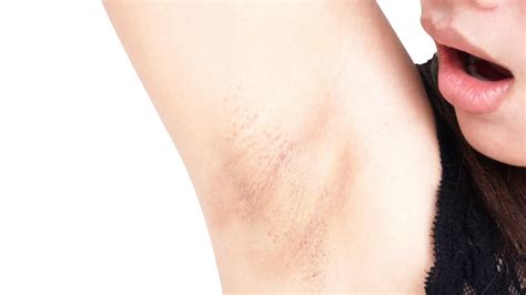 6 Common Causes of Armpits Rashes – Duradry