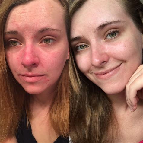 [B&A] What 6 months SCA advice did to my dry, flaky and bright red face ...