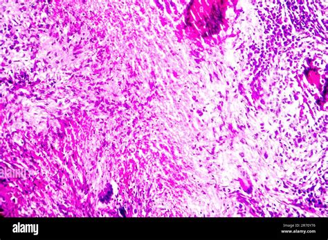 Caseous necrosis of lymphatic node, light micrograph, photo under ...