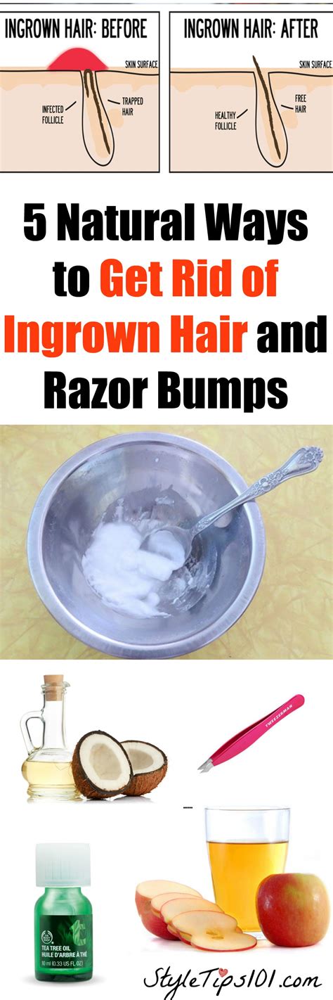 5 Ways to Get Rid of Ingrown Hair or Razor Bumps