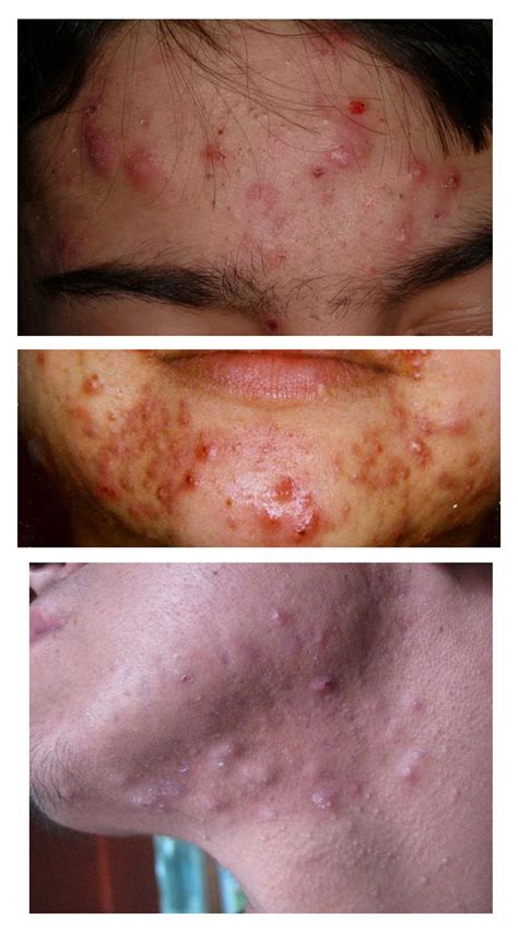 How to Recognize What Kind of Acne You Have | Innate Skin