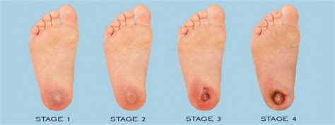 Click here to know about different stages of diabetic foot ulcer – HappyWalk - Orthopedic ...