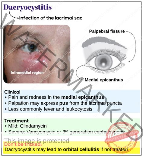 Dacryocystitis - Medicine Keys for MRCPs