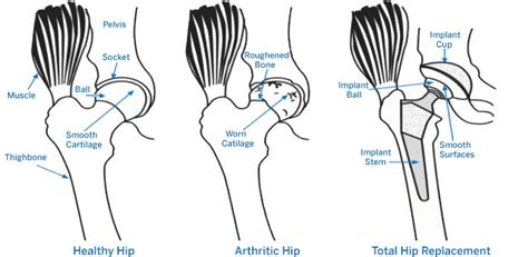 Hip Replacement Surgery: Procedure, Types and Risks | HSS