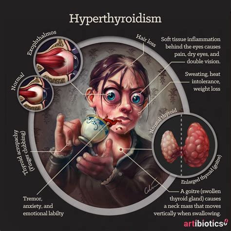 Pin on Hyperthyroidism & Hypothyroidism