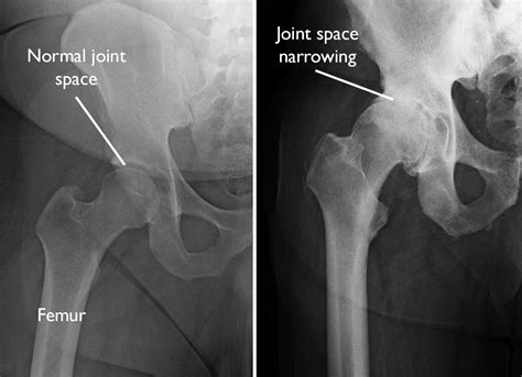 Arthritis: An Overview - OrthoInfo - AAOS