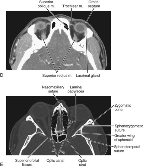 Orbit | Radiology Key