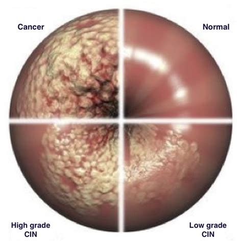 Cervical Intraepithelial Neoplasia