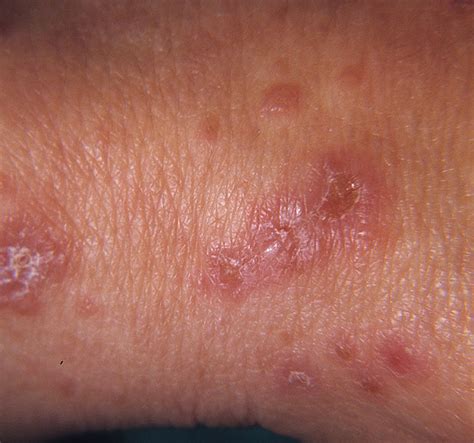 dermatitis herpetiformis pictures - pictures, photos