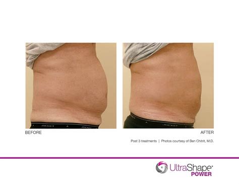 UltraShape Body Contouring & Fat Reduction