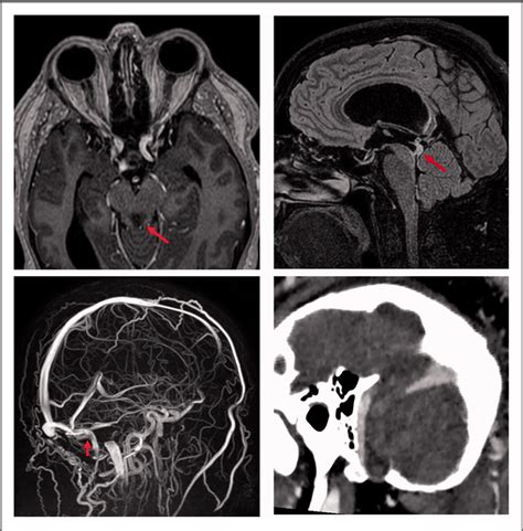 Transverse sinus stenting for treatment of papilloedema secondary to a large brain herniation ...