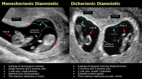 Fetal Twins Ultrasound Normal Vs Abnormal | Monochorionic/Dichorionic ...