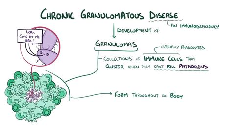 Chronic granulomatous disease: Video & Anatomy | Osmosis