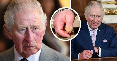 King Charles' 'sausage fingers': Doctor claims they've gotten worse