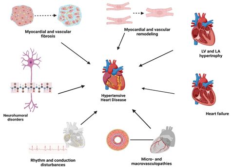 JCM | Free Full-Text | Hypertensive Heart Disease: A Narrative Review ...